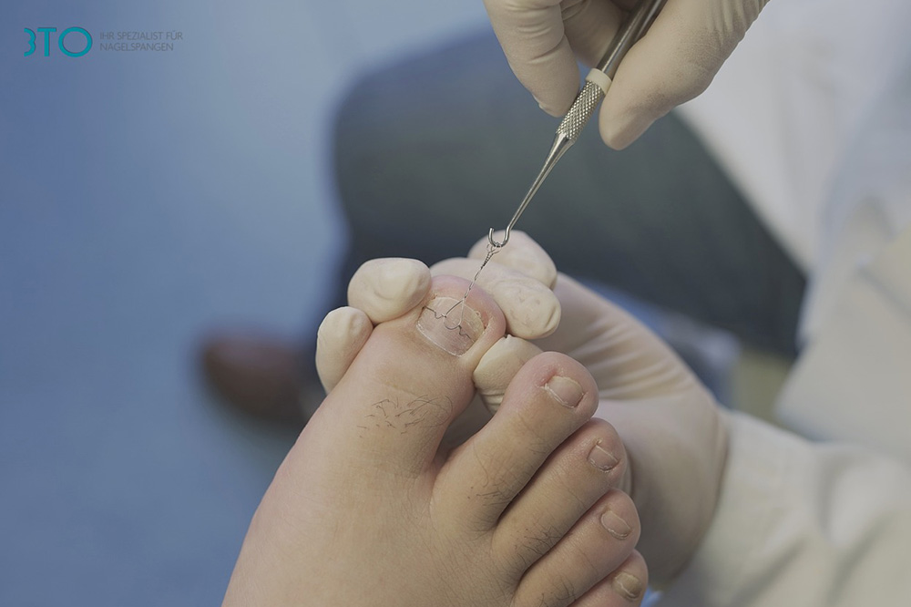 wrastający paznokieć